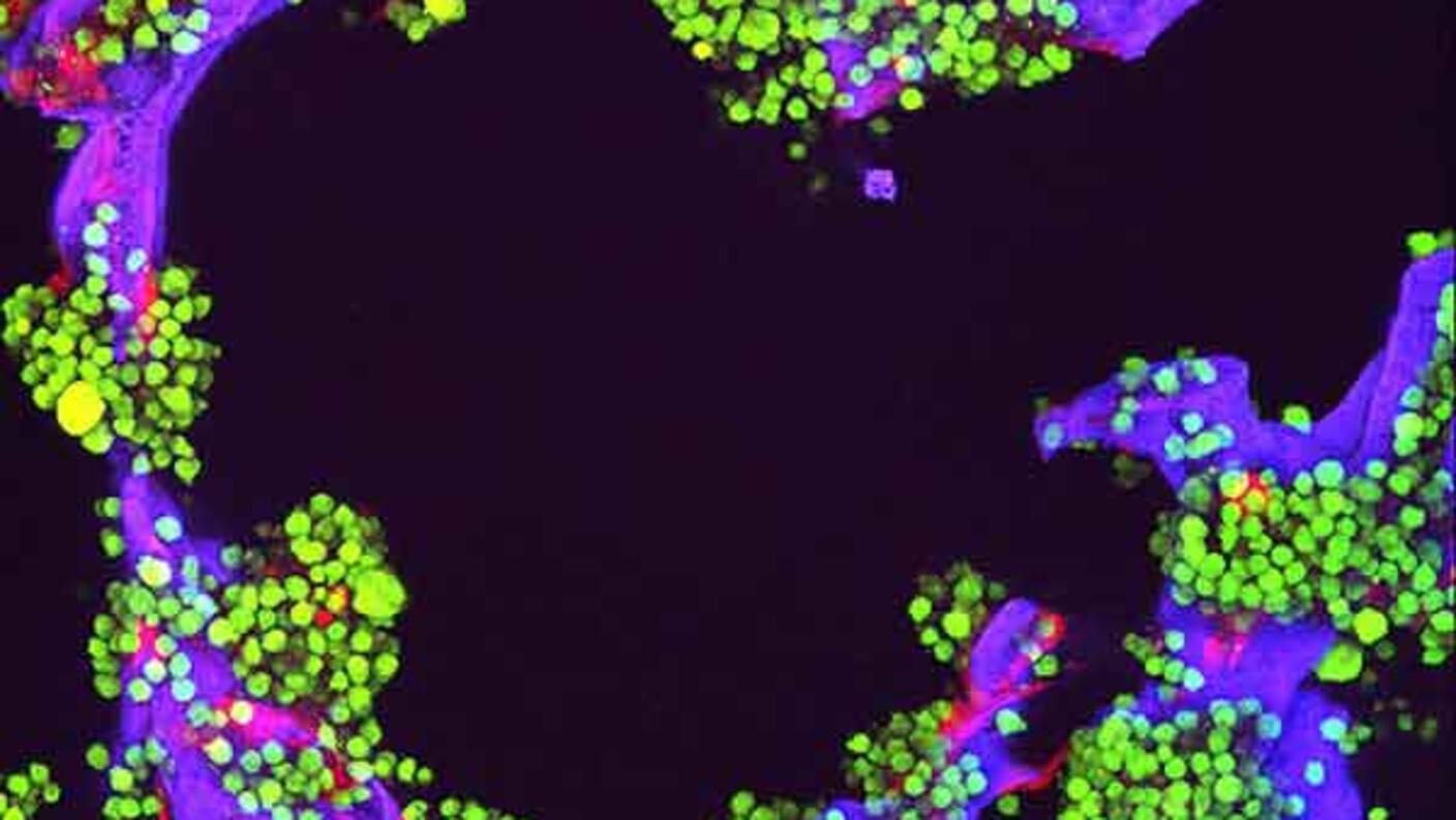 Fluorescent microscope image showing green myeloma tumor cells and red bone cells growing on a purple laboratory-made scaffold, used for research purposes.