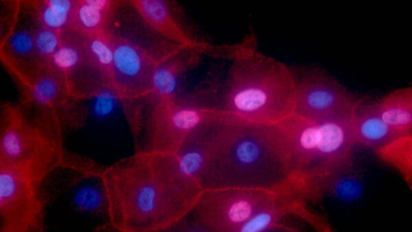 Photo of human breast cancer cells