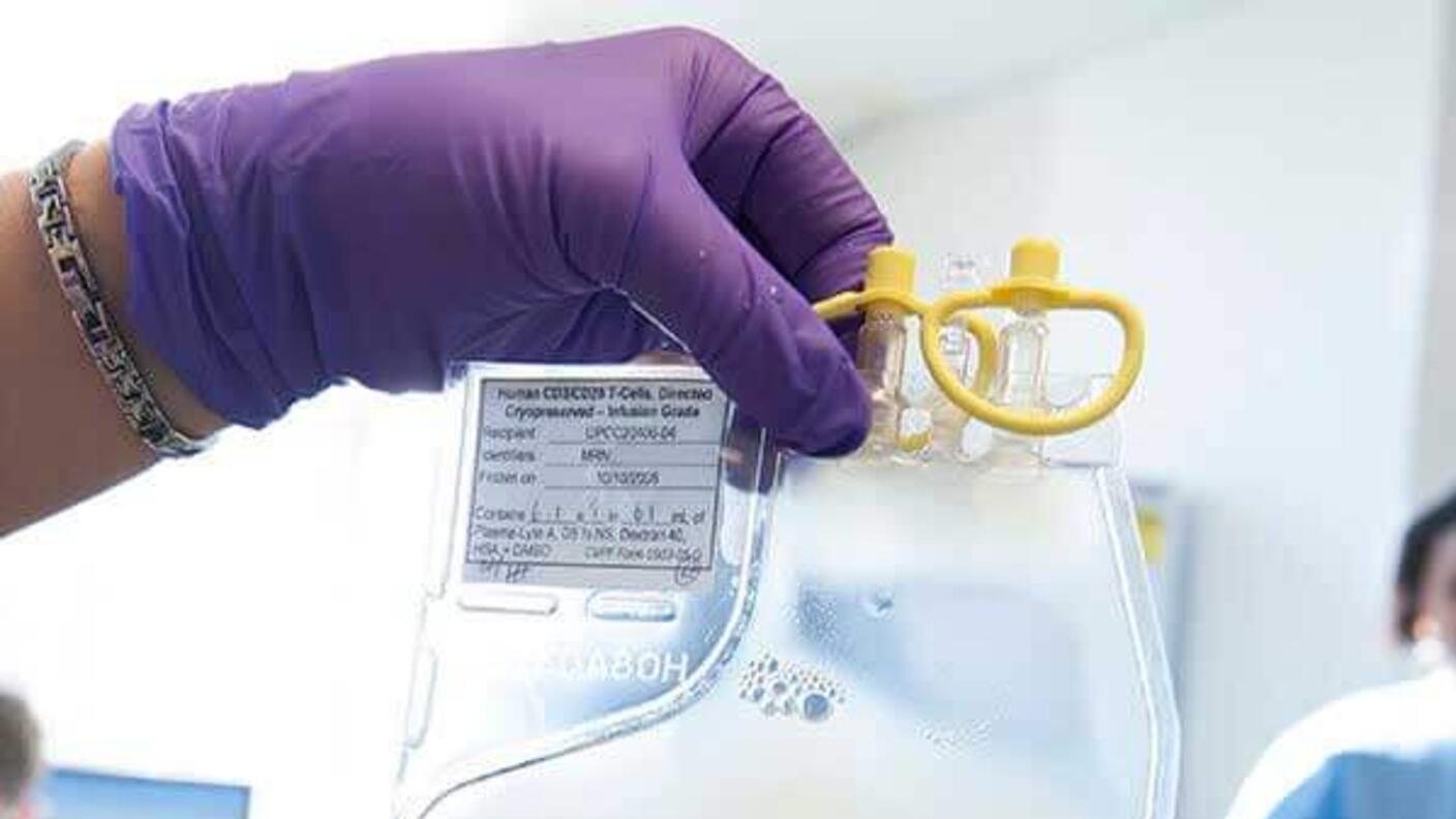 Person wearing a purple glove holds a transparent bag filled with a milky white liquid, the manufactured CAR T cells. The bag has yellow caps and a label with information.