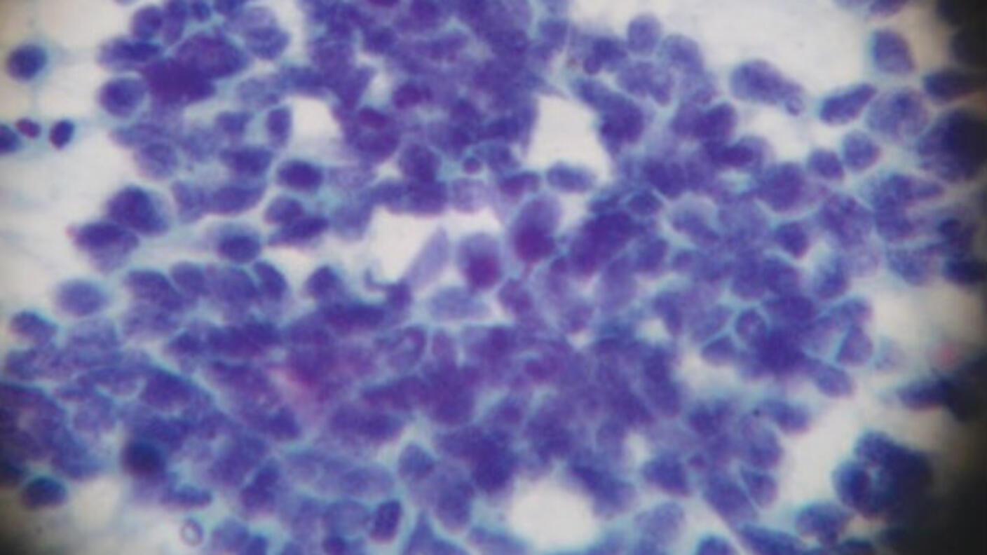 Image of small cell lung cancer cells