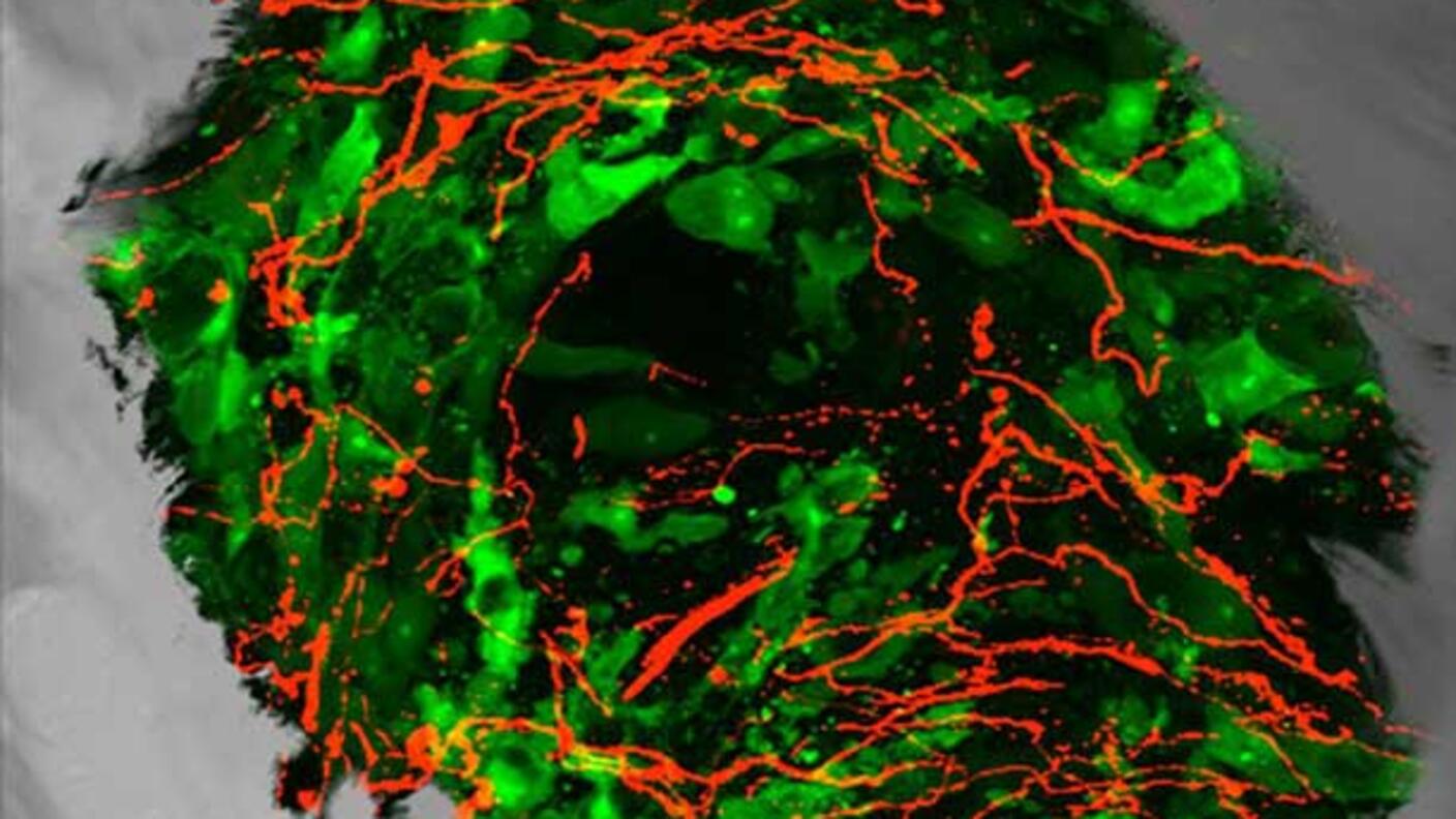 Fluorescent microscope image showing sensory nerve fibers in red infiltrating and growing into green prostate cancer cells that have metastasized to bone tissue.
