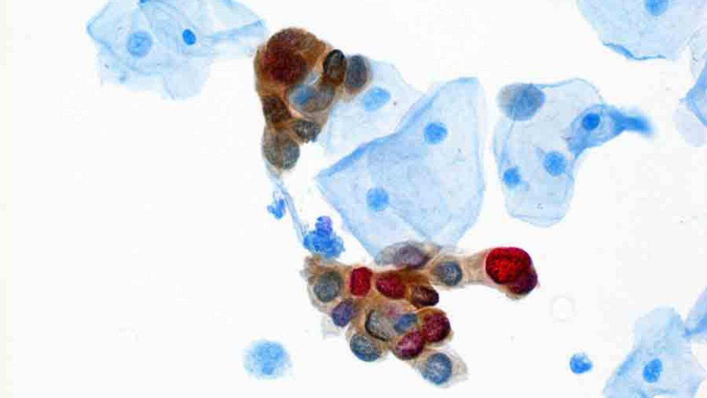 A pathology slide of a cervical tissue sample showing brown (p-16) and red (Ki-67) staining.