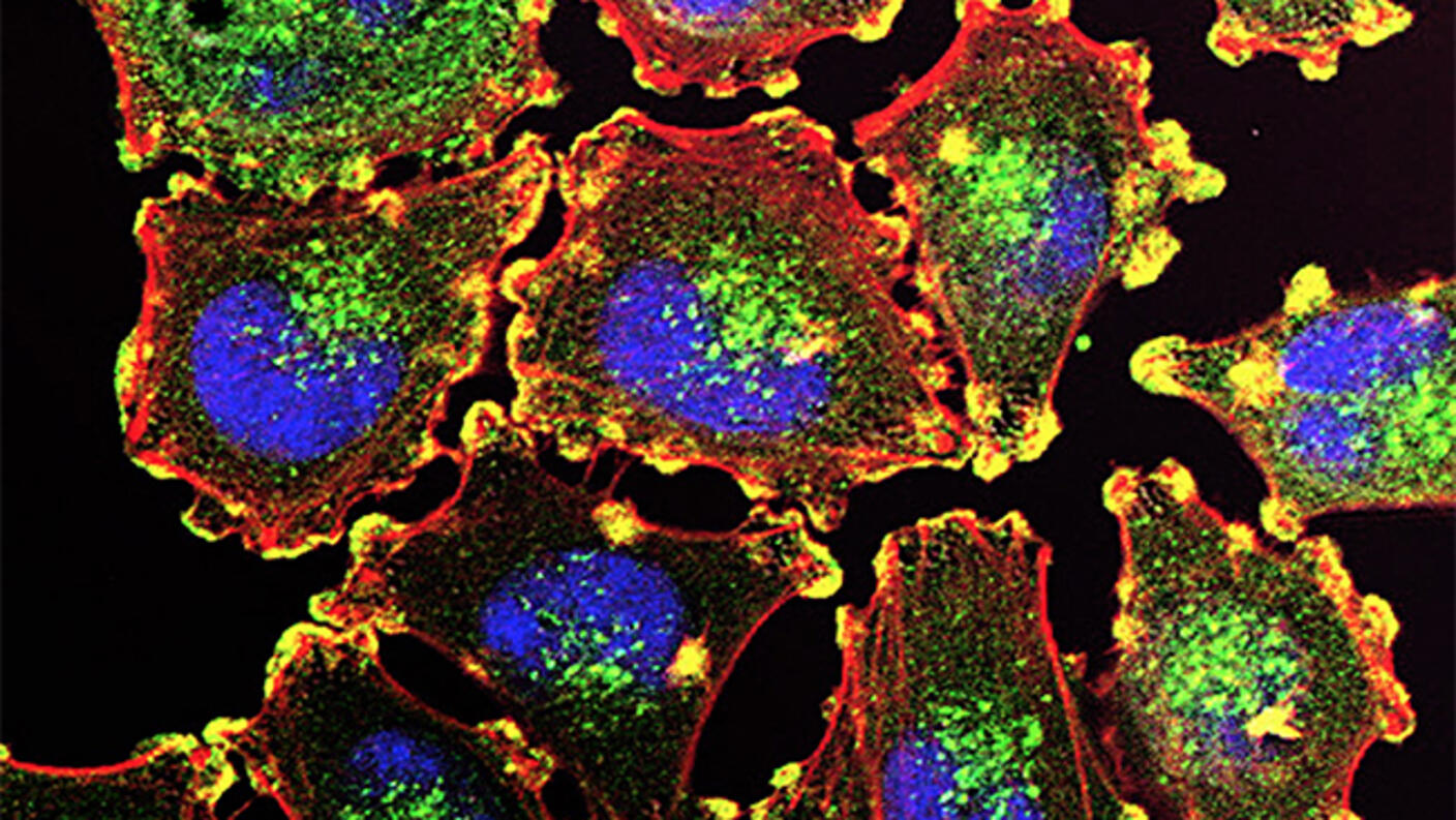 Fluorescence microscopy image of metastatic melanoma cells, with blue-stained nuclei, green-stained organelles, and red-highlighted cell membranes, illustrating cellular structure and protein distribution.