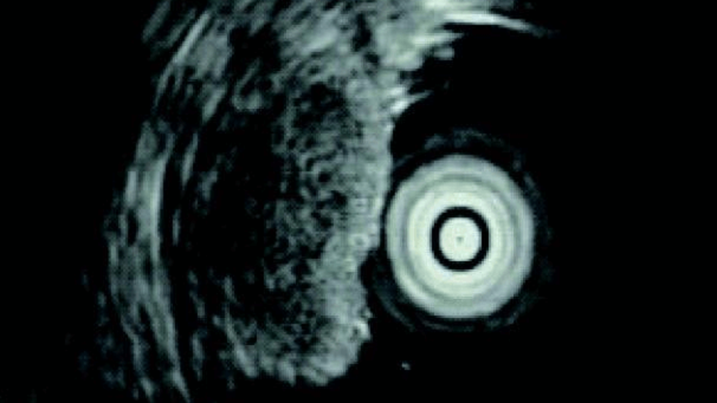An endoscopic ultrasound of a neuroendocrine tumor (NET) in the upper gastrointestinal tract (duodenum).