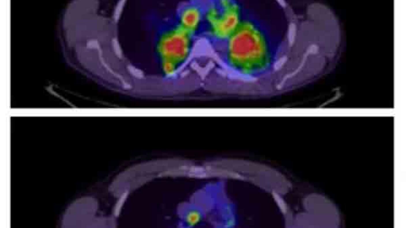 Before and after PET scan of patient treated with crizotinib.