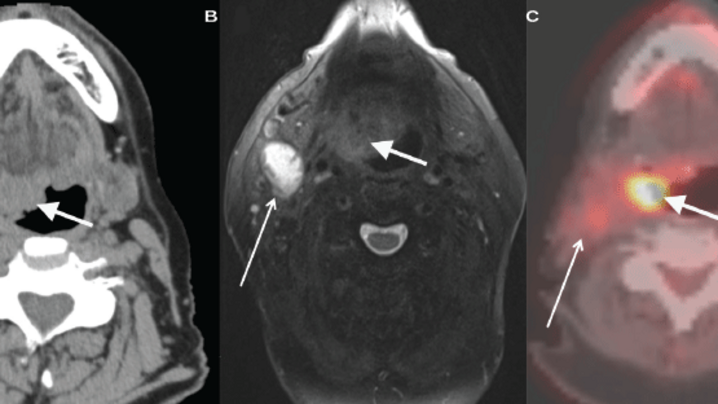 Three images of a patient with an HPV-positive oropharyngeal tumor. The first two are black and white; so is the last one, but it includes shades of red and yellow. In the middle, an arrow points at a large white shape. On the right, a different arrow points to a large yellow-white shape near the location of the white shape in the previous panel.