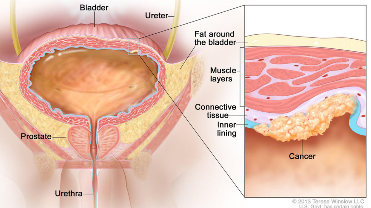 Illustration labeled “Stage I Bladder Cancer.” The main illustration labels the bladder, ureter, fat around the bladder, urethra, and prostate. A small cancer cluster inside of the muscle and fat layers of the bladder is linked to an inset illustration which labels the muscle layers, connective tissue, and inner lining of the bladder along with the actual cancer. 