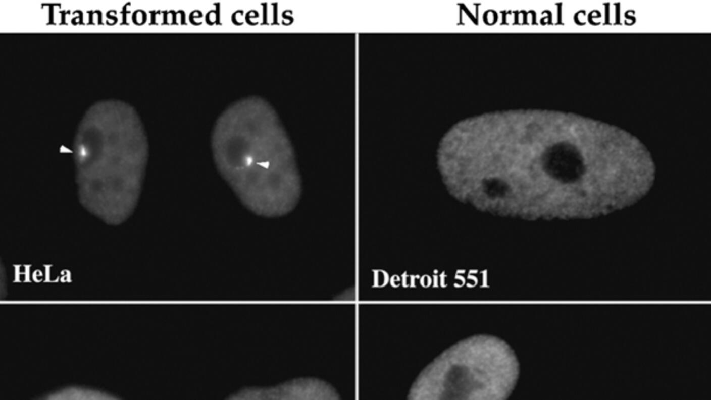 PNCs found in cancer cells (arrows) but not in normal cells.