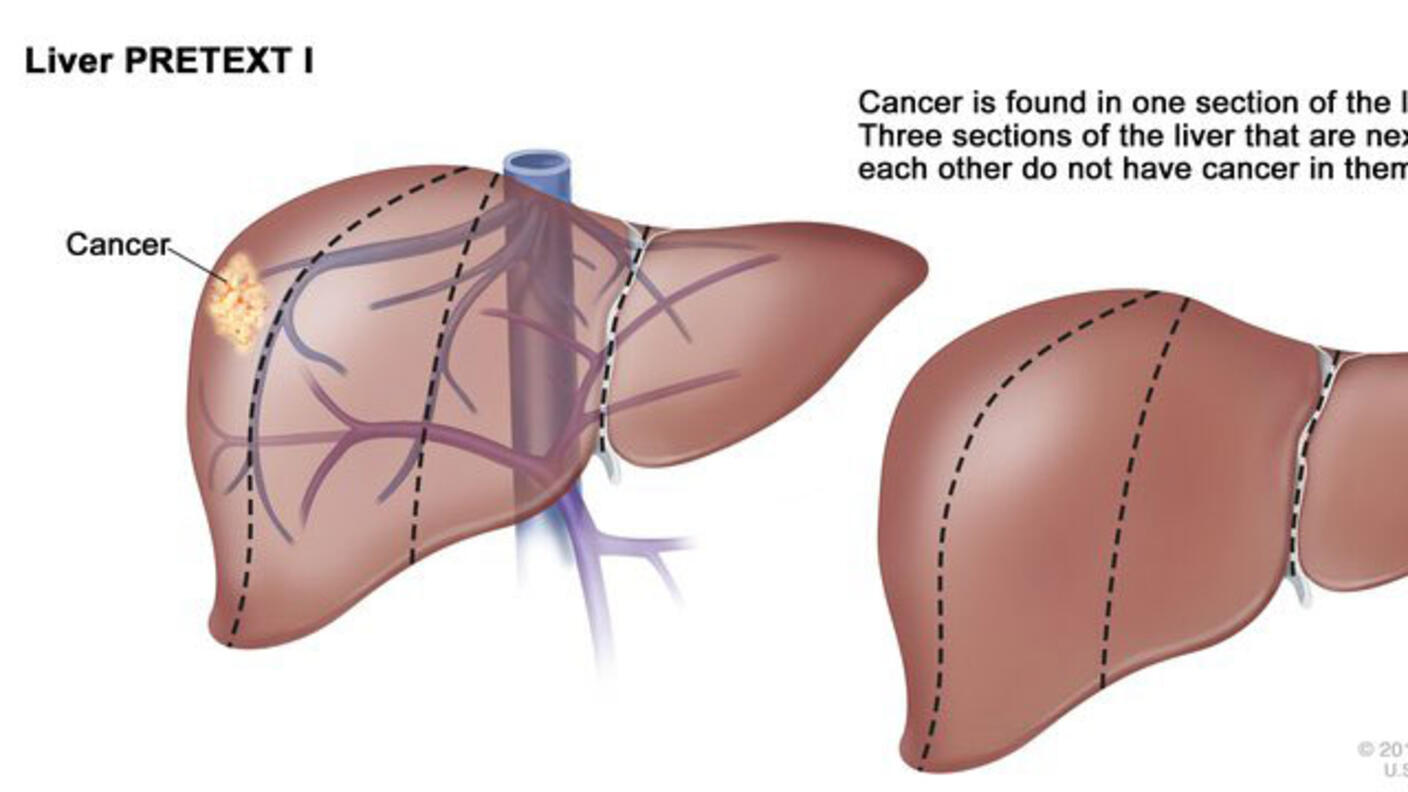 Illustration titled “Liver PRETEXT I”. Two depictions of the liver are side by side. The left labels a mass of cancer on the liver and shows veins behind the liver. The right shows the cancer mass in a different position on the liver and doesn’t show any veins. Above both illustrations, text reads “Cancer is found in one section of the liver. Three sections of the liver that are next to each other do not have cancer in them.”