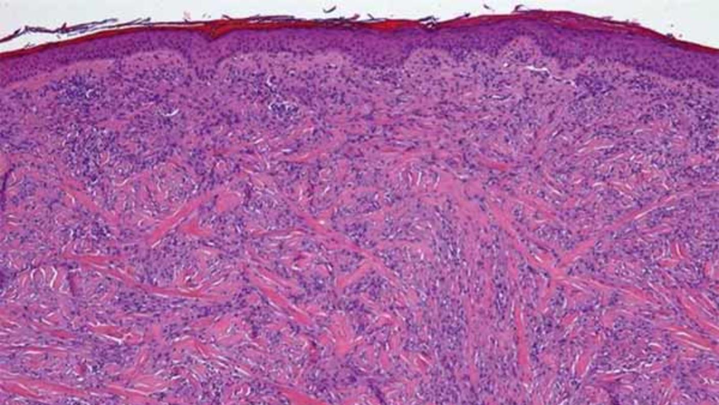 Microscopic image of desmoplastic melanoma showing spindle-shaped tumor cells embedded in dense, fibrous tissue stained in pink and purple.