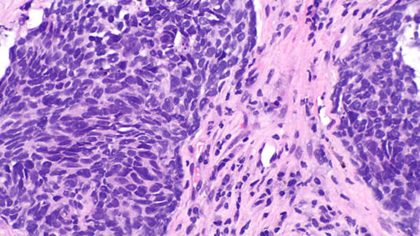 Microscopic tissue sample showing nonsquamous non-small cell lung cancer cells with purple-pink staining, displaying irregular cellular structure and abnormal growth patterns.
