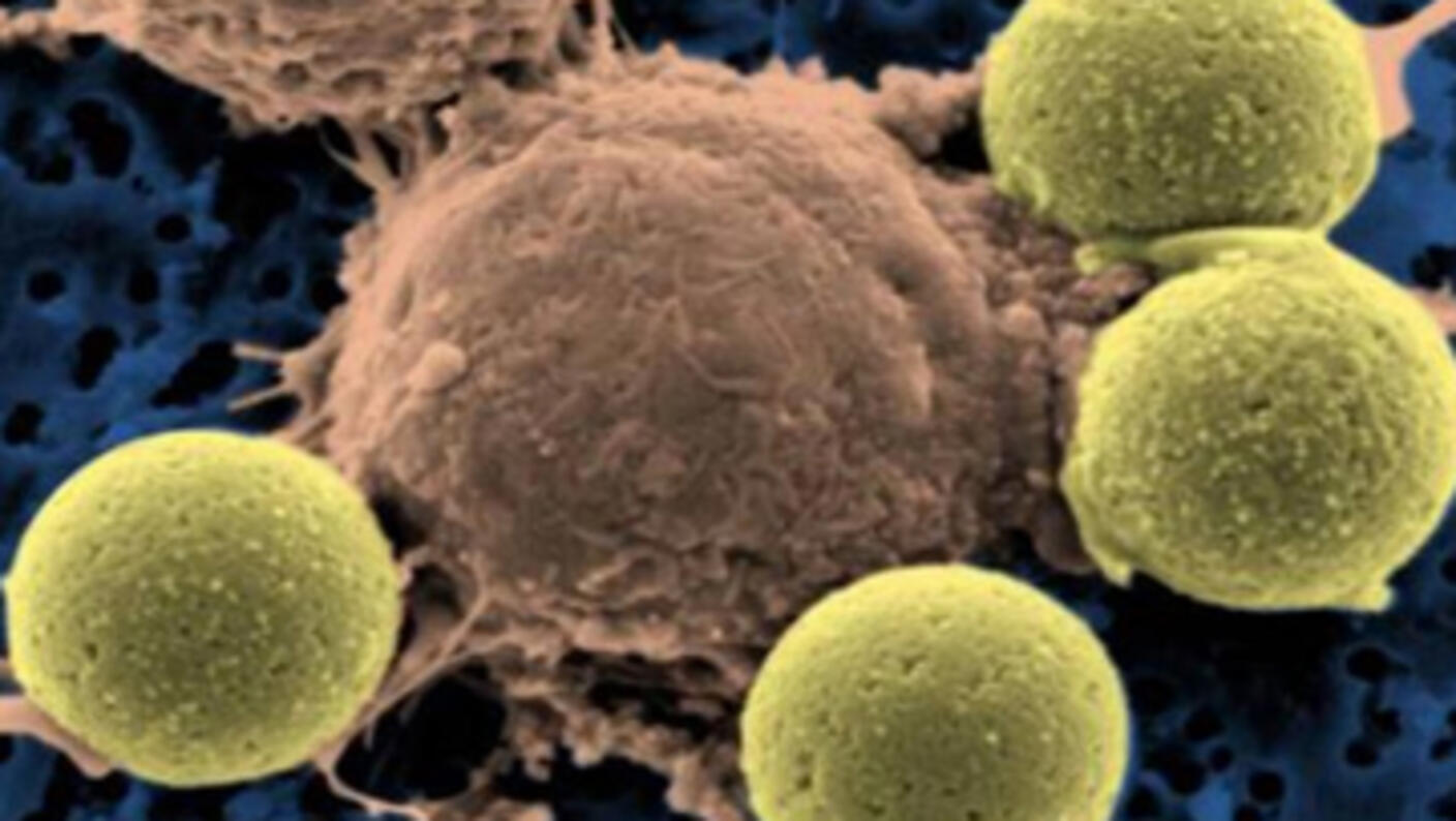 A large brown cell - a CAR T cell - surrounded by four smaller, pea-green beads. The CAR T cell has more irregularities on the surface than the beads.