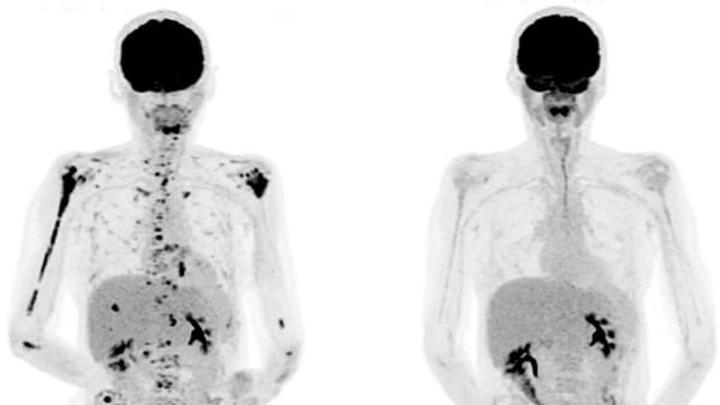 Two side-by-side PET scans of an adult body with multiple myeloma. The scans are mostly light grey; in the left scan, there are black areas spread throughout the shoulders, right arms, and throughout the lower body. On the right scan, after the BCMA-targeted CAR T cell treatment, there are approximately 80% less black areas; those that remain are mainly located in the midsection.