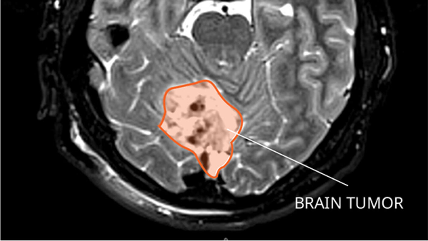 MRI of a mouse brain with a tumor.