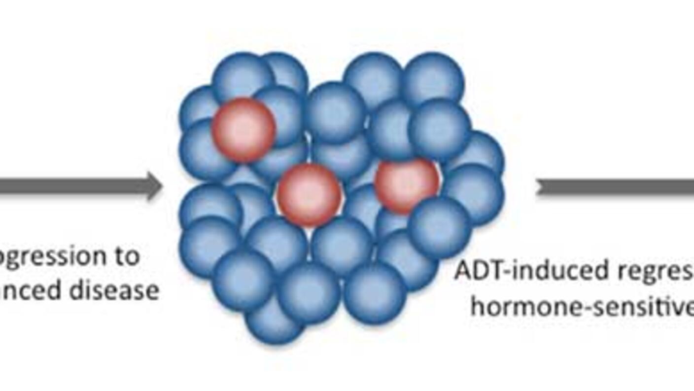 Diagram showing prostate cancer progression and regression with ADT, highlighting hormone-sensitive and resistant cells.