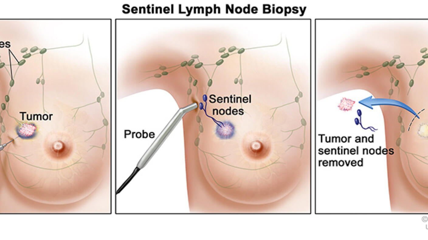 Illustration showing a three-step procedure for sentinel lymph node biopsy in breast cancer treatment. The first panel depicts an injection of a radioactive substance or dye near a tumor to identify lymph nodes. The second panel shows a probe detecting sentinel nodes. The third panel illustrates the removal of the tumor and sentinel nodes.