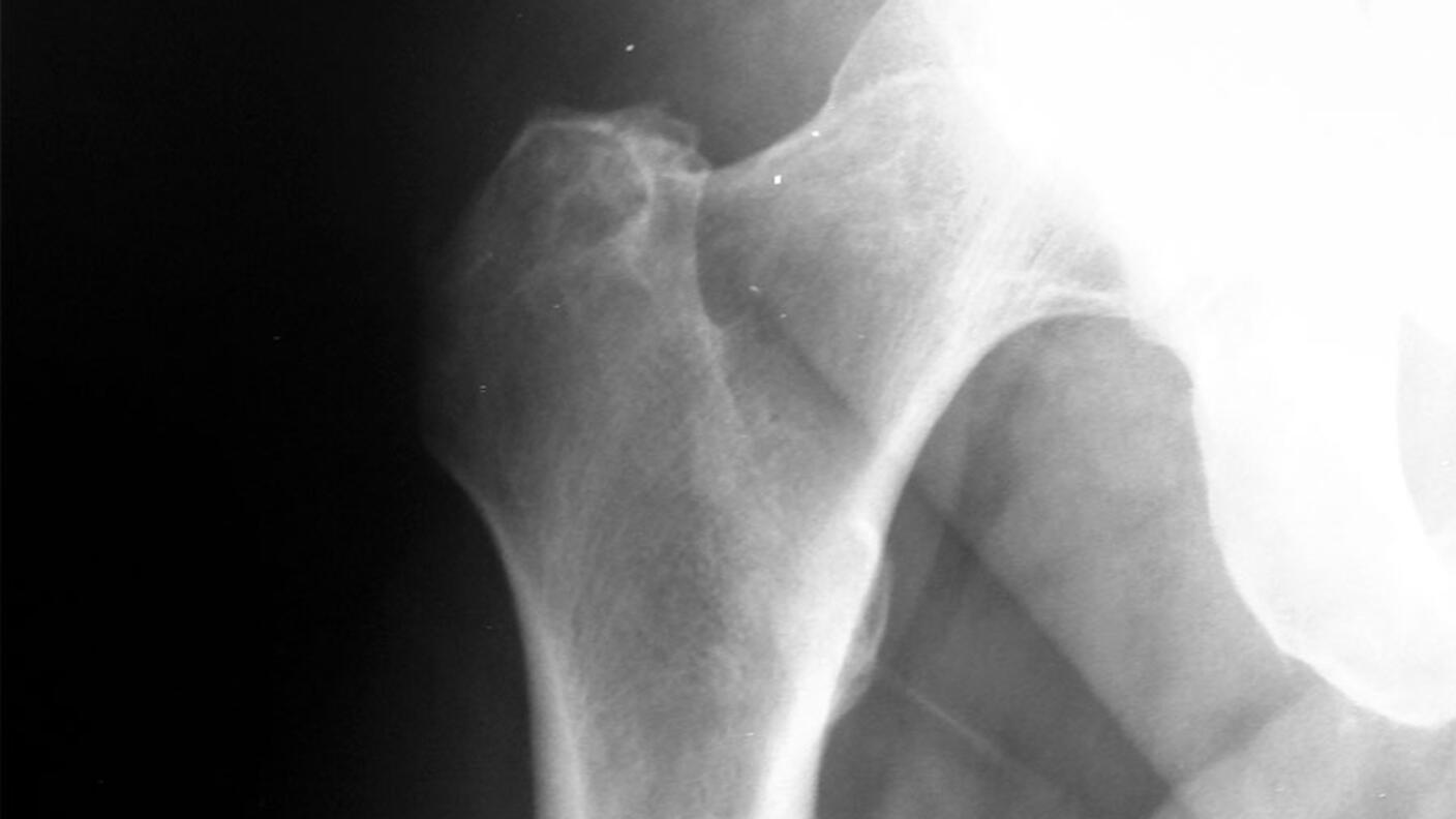 X-ray image showing the hip and upper thigh bone area, revealing a metastatic tumor that has spread to the bone tissue.