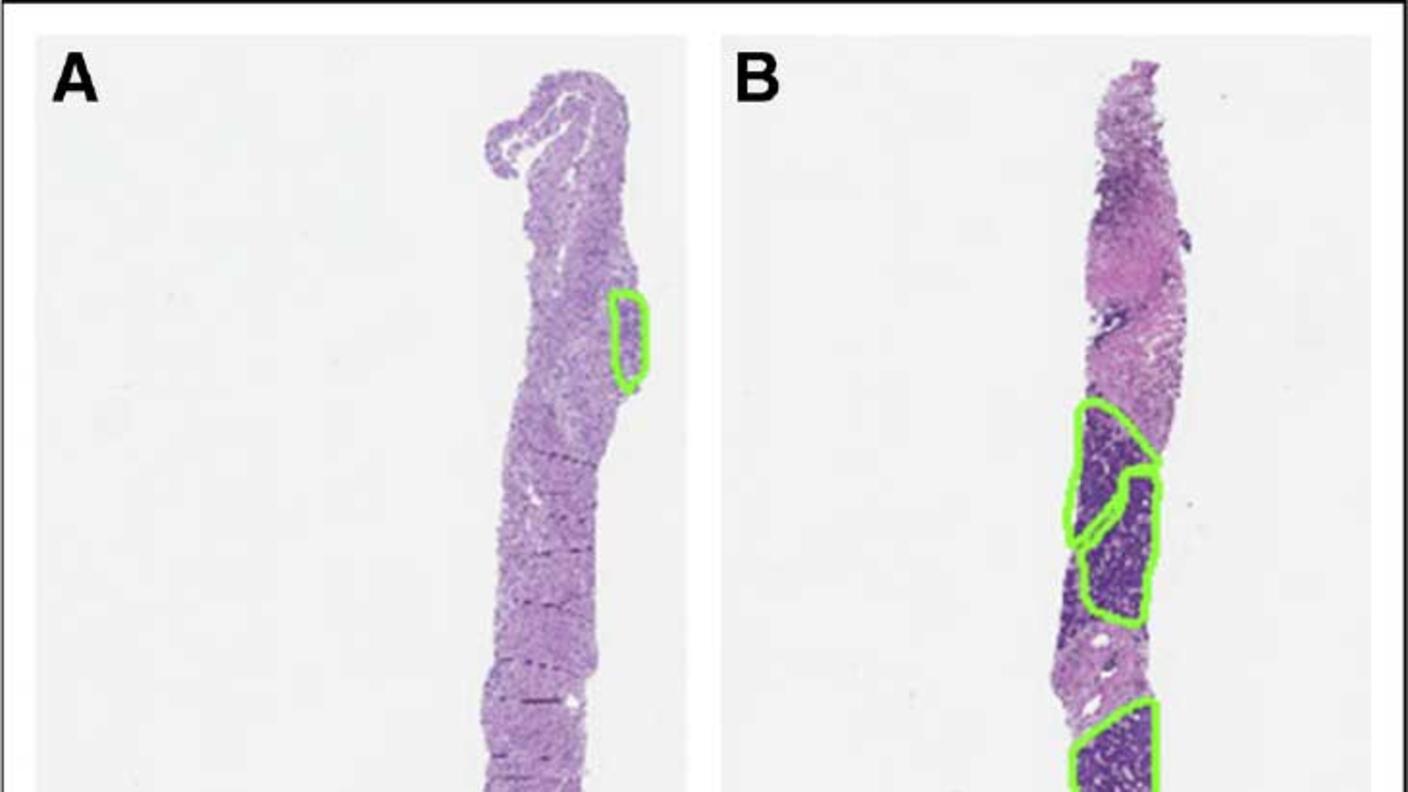 Two biopsy samples (A and B) from the same patient showing dramatically different amounts of tumor tissue, with sample A containing very little tumor tissue (small green box) while sample B contains much more tumor tissue (multiple larger green boxes)