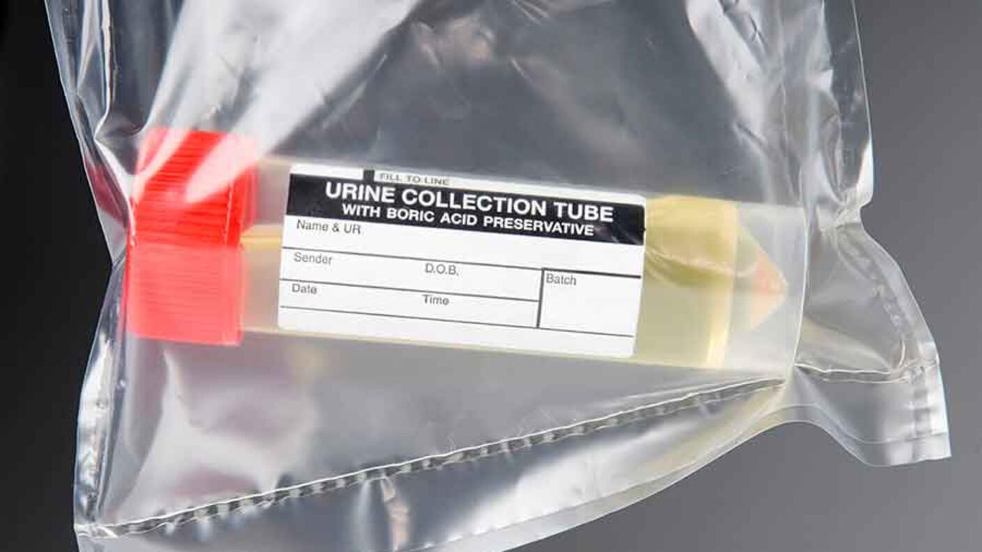 Urine collection sample inside a sealed plastic bag.