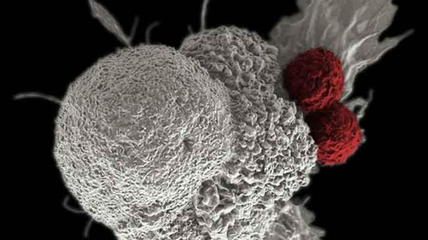 Electron microscope image showing red cytotoxic T cells attacking a white oral squamous cancer cell, demonstrating how immune checkpoint inhibitors help T cells destroy tumor cells.