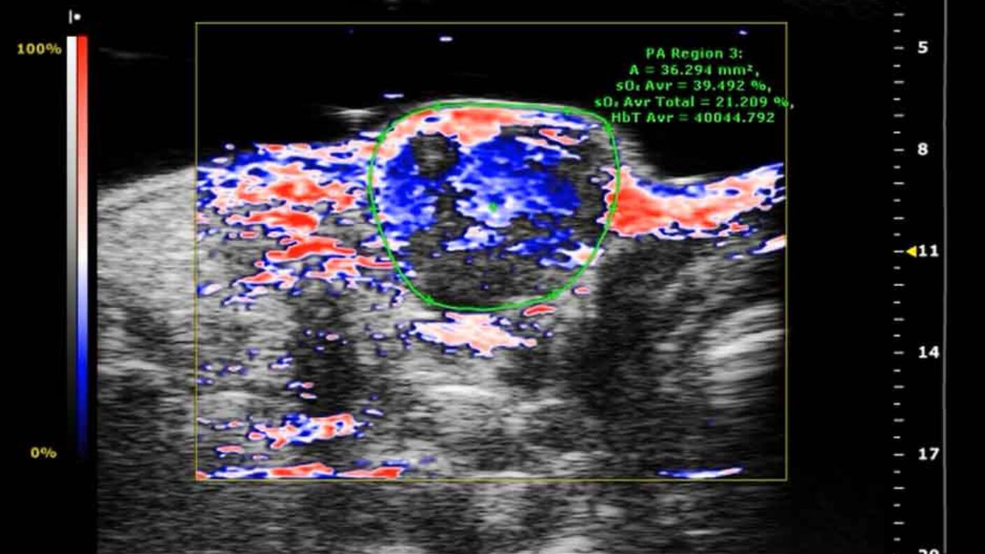 Photoacoustic ultrasound image displaying oxygen distribution (shown in red) within tumor tissue following microbubble delivery, with blue and white regions indicating other tissue characteristics and measurement data displayed on the screen.