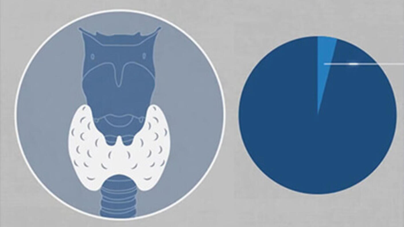 An illustration of a thyroid (in white) along with a larynx and trachea in blue. Next to it, an unlabeled pie chart. The pie chart has a smaller, medium-blue pie slice surrounded by a larger, dark-blue slice.