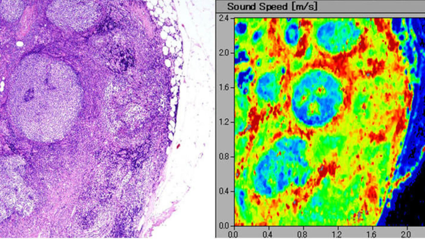 Follicular lymphoma cells stained purple (left) and a scanning acoustic microscopy image of follicular lymphoma cells in neon green, red, and blue (right)