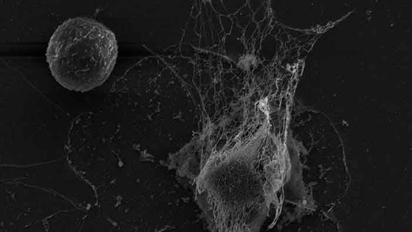 A normal neutrophil (left) next to a neutrophil that has released a trap that captures and kills pathogens.