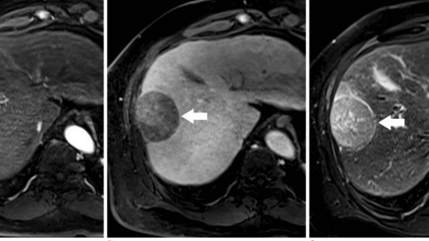 A series of three liver MRI images labeled A, B, and C showing different imaging sequences of the same liver with a mass (indicated by white arrows in each image). Each image shows the same liver lesion with different contrast and visibility depending on the MRI sequence used