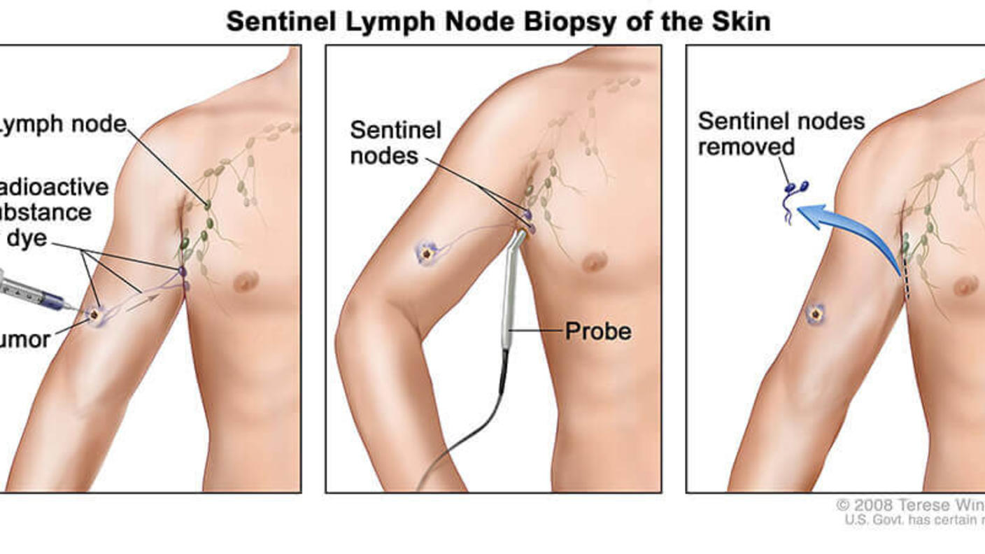 Illustration showing a three-step procedure for sentinel lymph node biopsy in skin cancer treatment. The first panel depicts an injection of a radioactive substance or dye near a tumor to identify lymph nodes. The second panel shows a probe detecting sentinel nodes. The third panel illustrates the removal of the sentinel nodes.