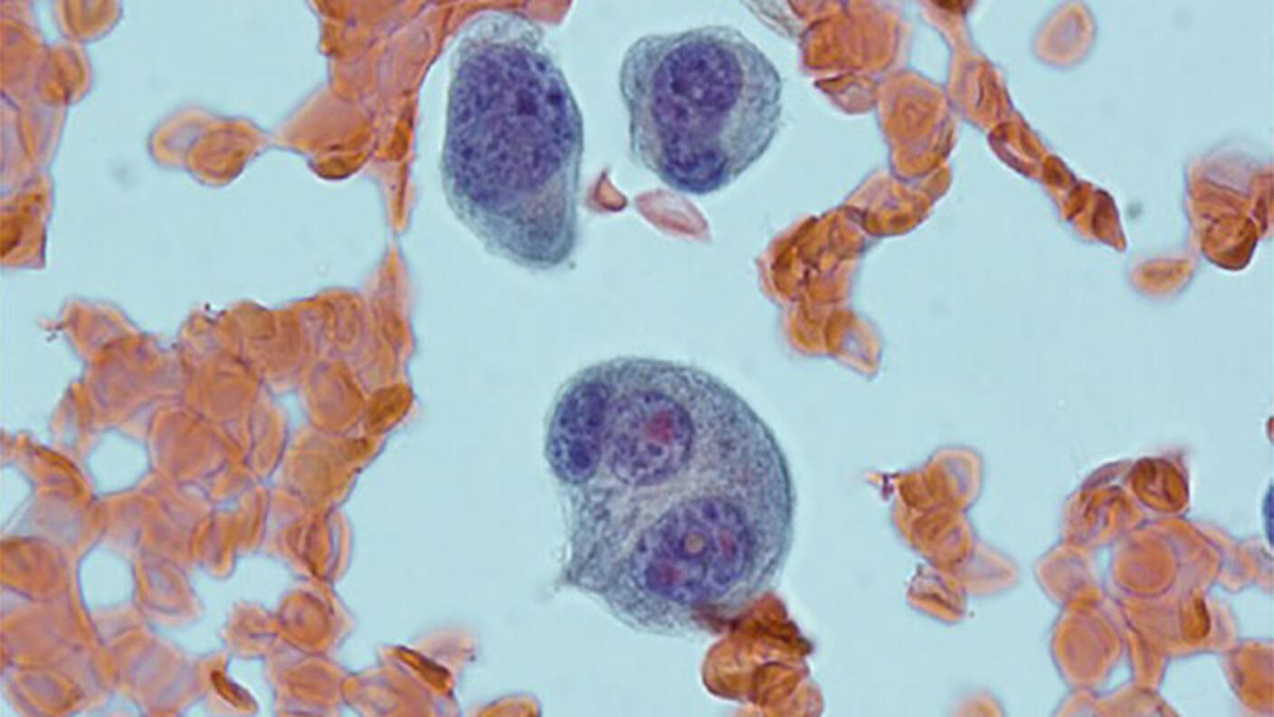 A microscopic view of smoldering myeloma. Scattered cells are colored in pink and red hues; the smoldering myeloma, which is shown as three large clumps, is colored purple.