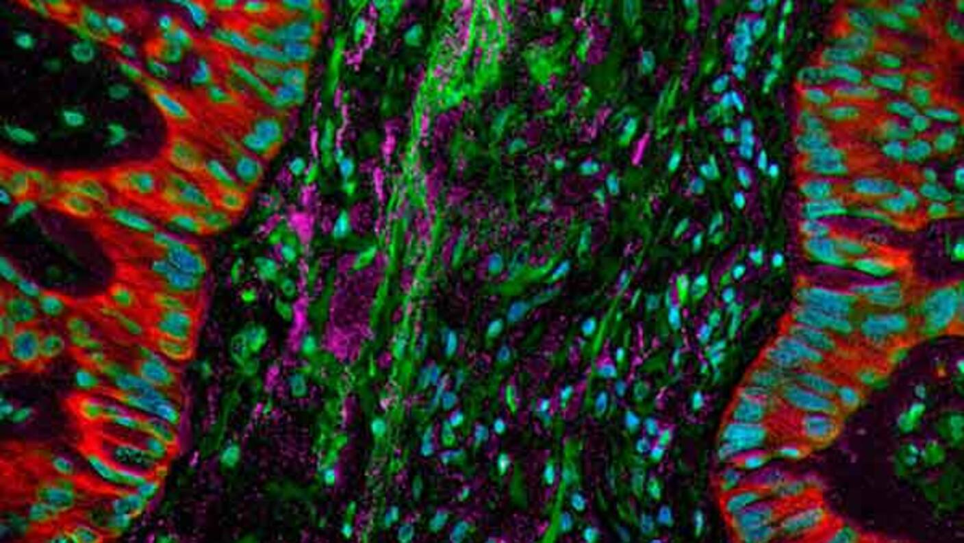 Fluorescent microscope image of a lung tumor showing cancer cells in red with green and blue highlighting other cellular structures and tissue components.