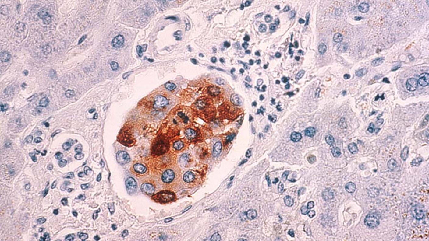 Microscopic image of liver tissue showing metastatic breast cancer cells highlighted in brown staining, surrounded by normal liver tissue with blue-stained nuclei.