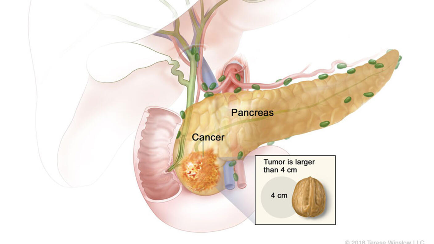 An illustration labeled “Stage IIA Pancreatic Cancer” which labels the pancreas and highlights an area on the pancreas labeled cancer. The area labeled cancer is expanded to an inset box with the title “Tumor is larger than 4 cm”, which shows an almond next to a grey circle measuring 4cm for size comparison.