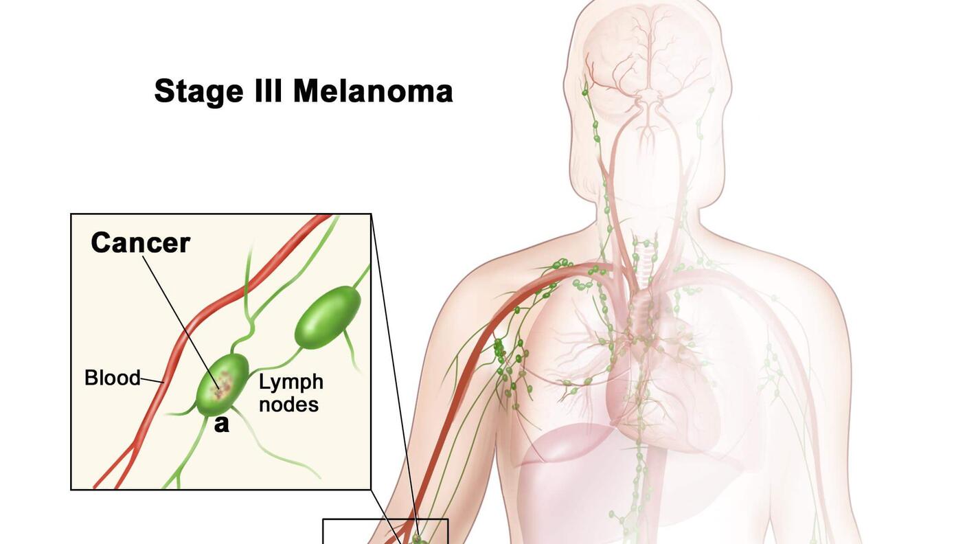 Illustration of Stage III Melanoma. The image depicts the human body with a focus on the lymphatic and circulatory systems. A primary tumor is shown on the arm, with cancer spreading to nearby lymph nodes. Insets highlight cancer involvement in lymph nodes near blood vessels as well as lymph vessel proximity to the primary tumor. Labeled features include lymph vessels, matted lymph nodes, and a primary tumor measuring 2 cm.
