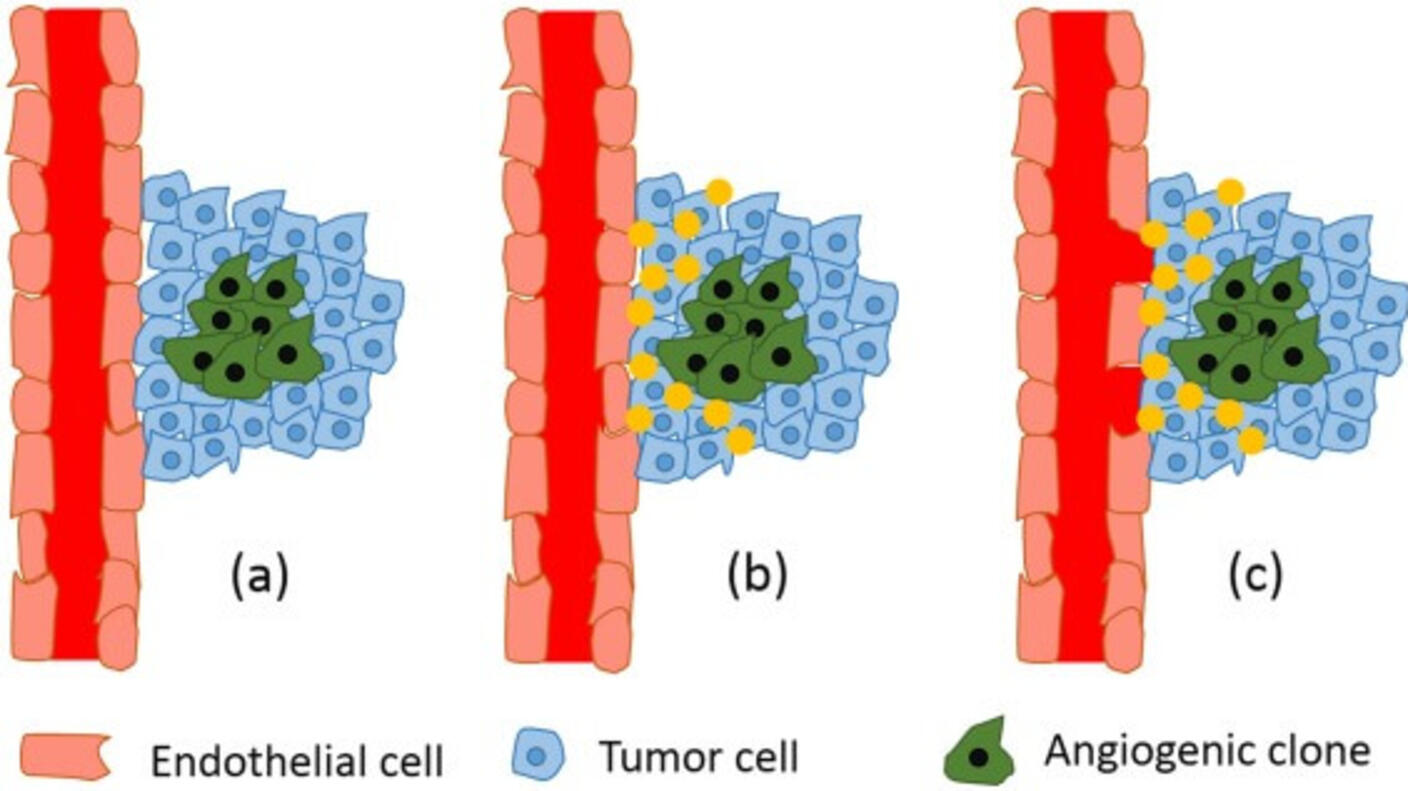 Diagram of the stages of tumor-induced angiogenesis, from angiogenic tumor clones releasing pro-angiogenic signals to new blood vessel growth toward the tumor.