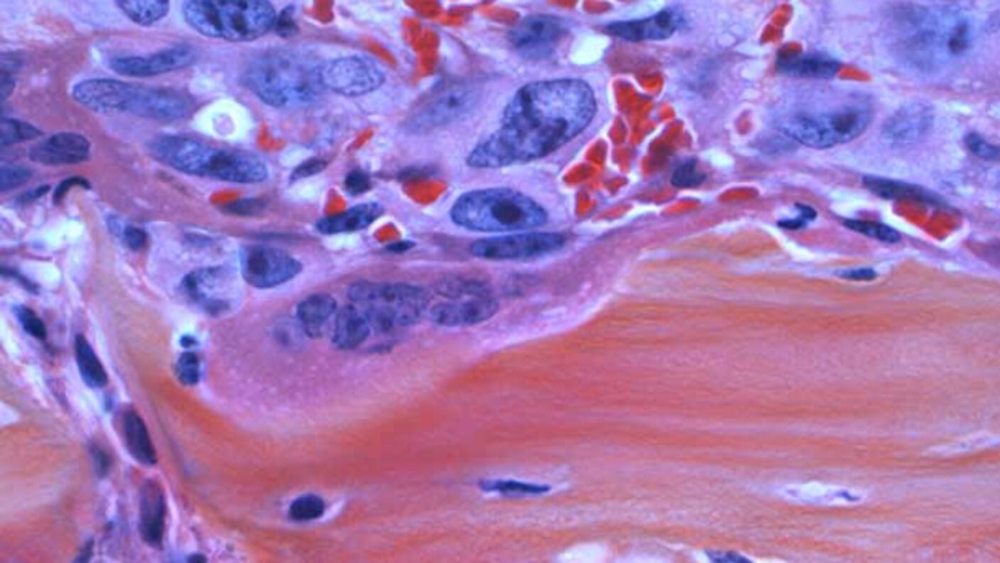 Microscopic image showing cancer cells (purple) invading bone tissue (orange), demonstrating how prostate cancer metastasizes to bone causing pain and structural damage.
