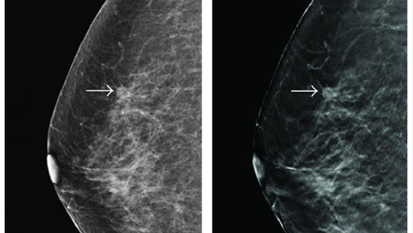 Breast nodules detected during screening by standard 2D digital mammogram (left) and tomosynthesis (right).