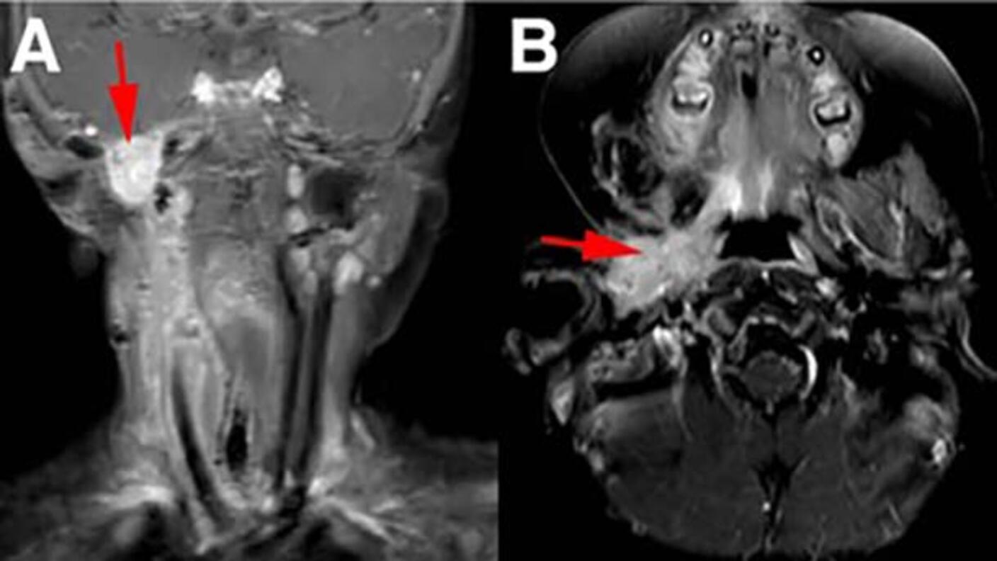Four MRI images showing before (A, B) and after (C, D) treatment of infantile fibrosarcoma with larotrectinib, demonstrating significant tumor reduction in the neck and oral cavity areas marked with red arrows.