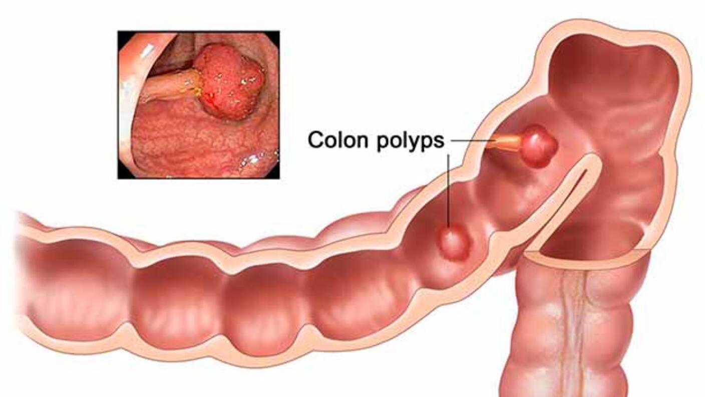 Close-up illustration of a section of the colon with two polyps, which are labeled. A small inset photograph in the top left shows a photo of a colon polyp.