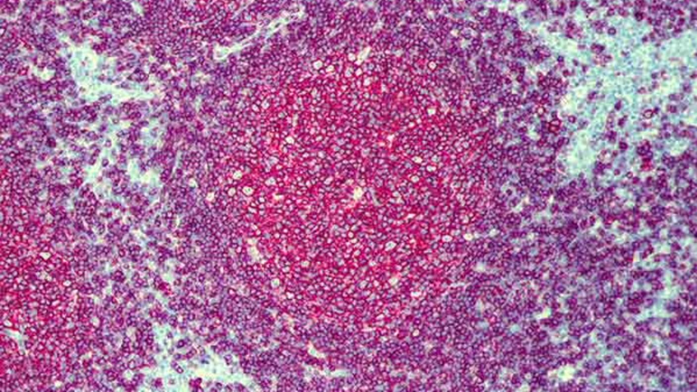 Microscopic pathology slide of follicular lymphoma tissue, stained in purple and pink, showing the characteristic follicular pattern of this type of cancer.
