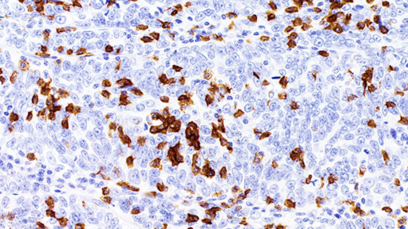 Histological image showing lesions in fallopian tube tissue, suggesting origins of high-grade serous ovarian cancer.