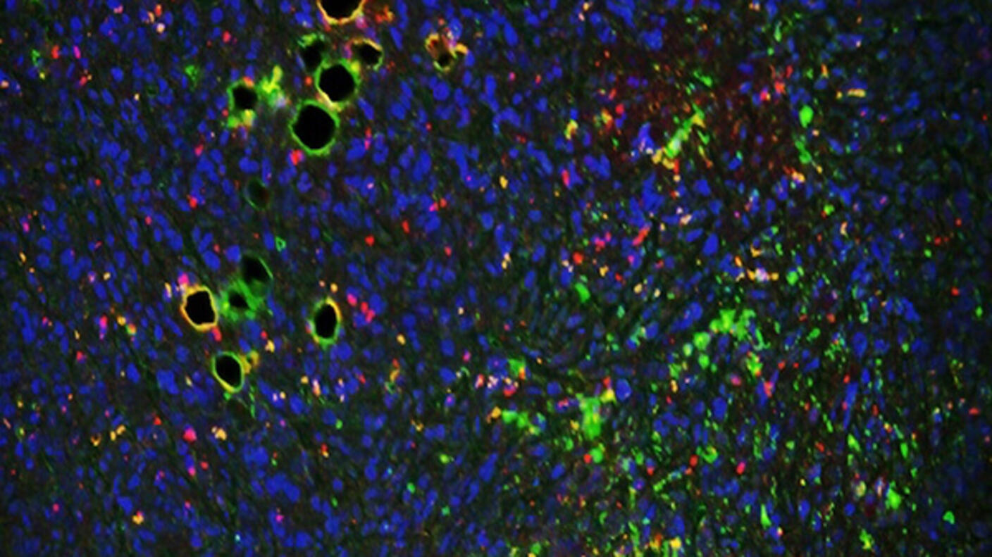 A microscopic view of breast cancer cells