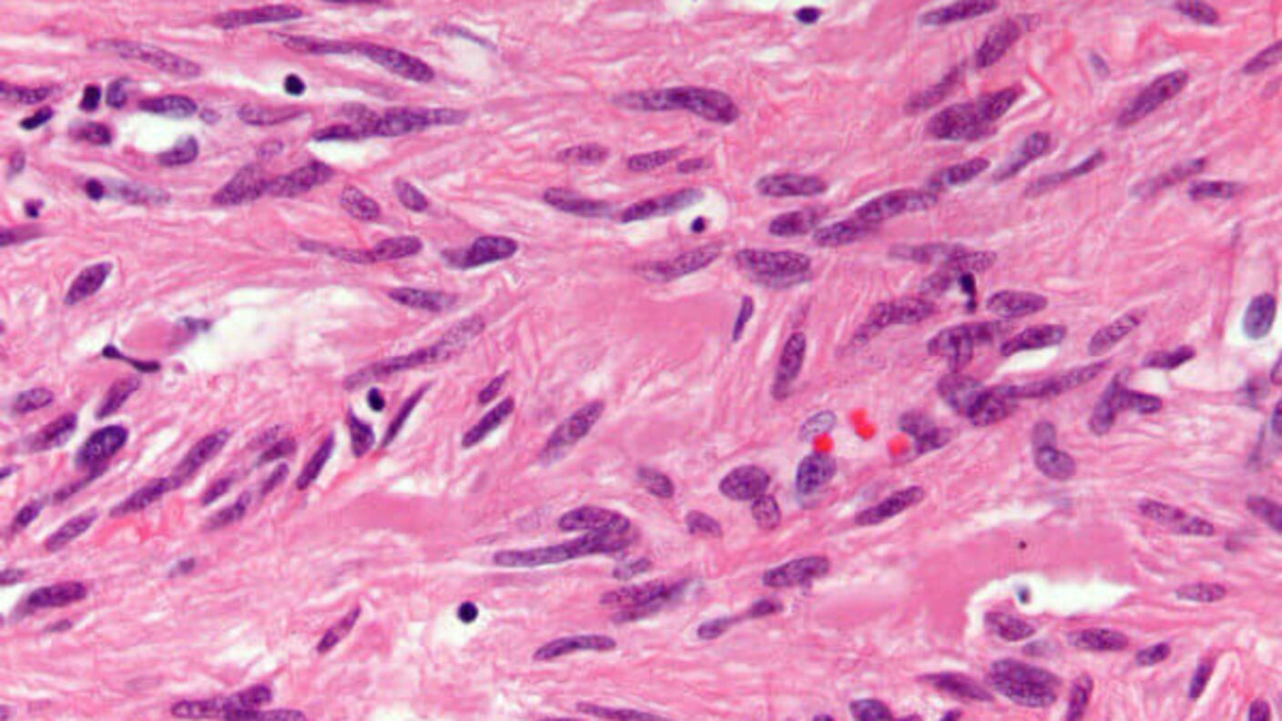 A pathology slide of a gastrointestinal stromal tumor.