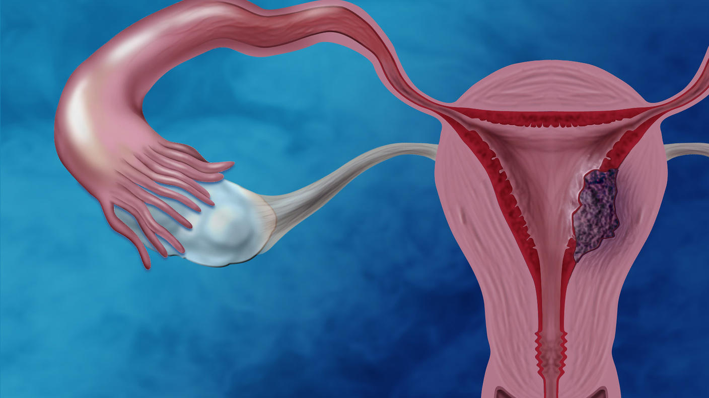 Illustration of the female reproductive system showing cancer cells in the endometrium.