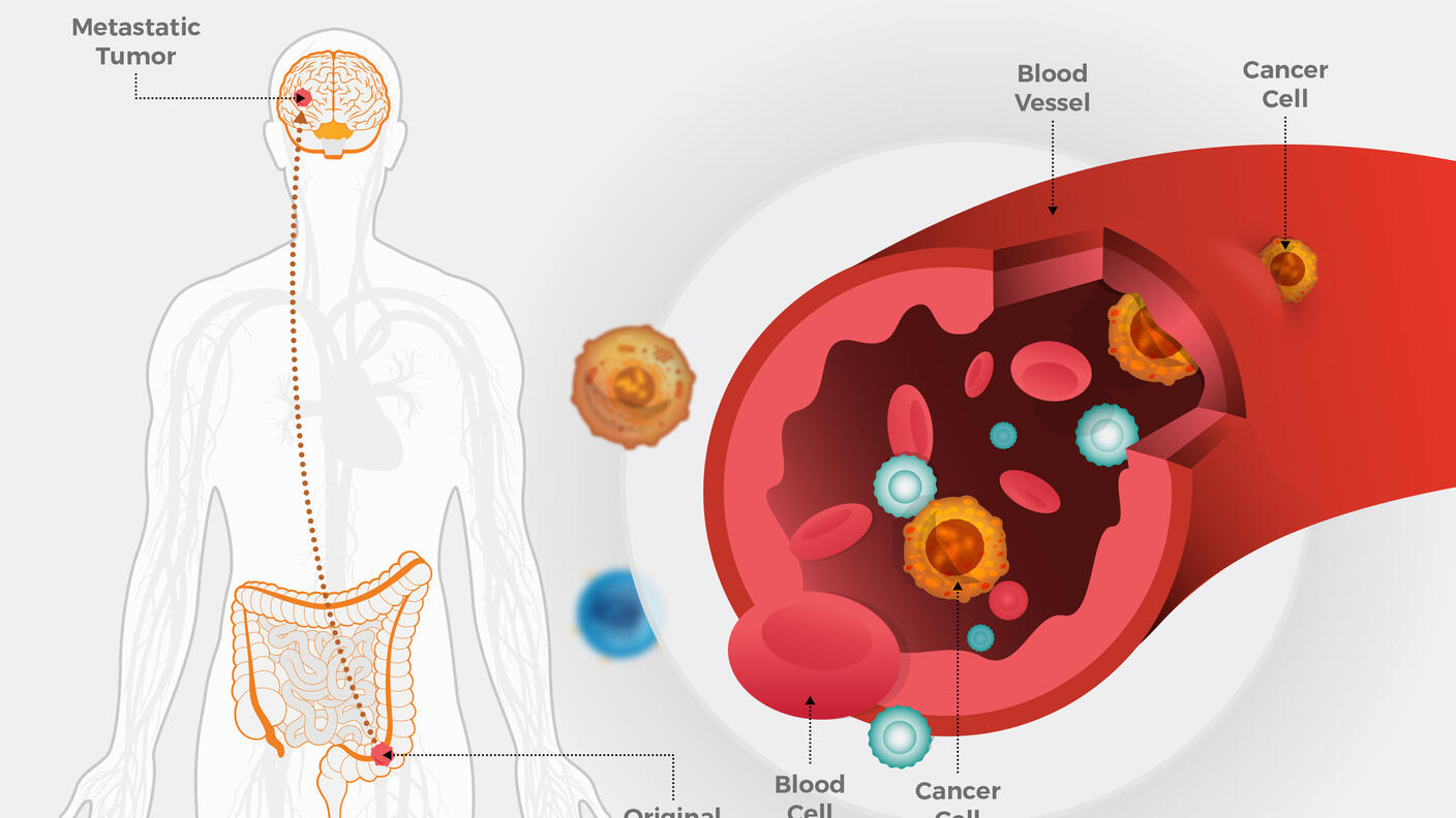 A two panel illustration. On the left, a human body with detailed illustrations of the brain and intestines. The brain has a circle labeled Metastatic Tumor, and an arrow points from the tumor to a circle in the intestine, labeled Original Tumor. On the right, a close up of a blood vessel, labeling the blood vessel, cancer cell, blood cell, and cancer cell inside the bloodstream.