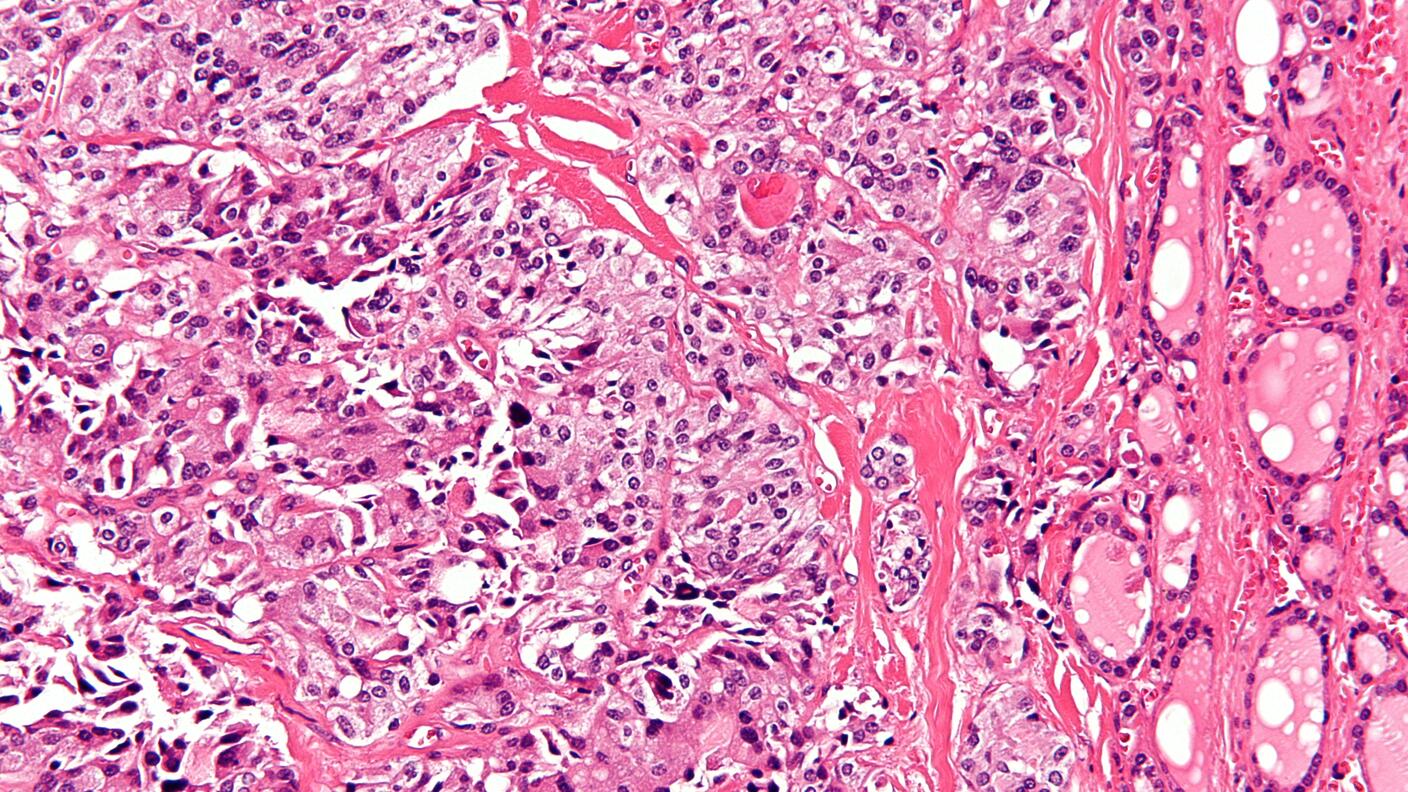 Photo taken through a microscope to show medullary thyroid carcinoma.