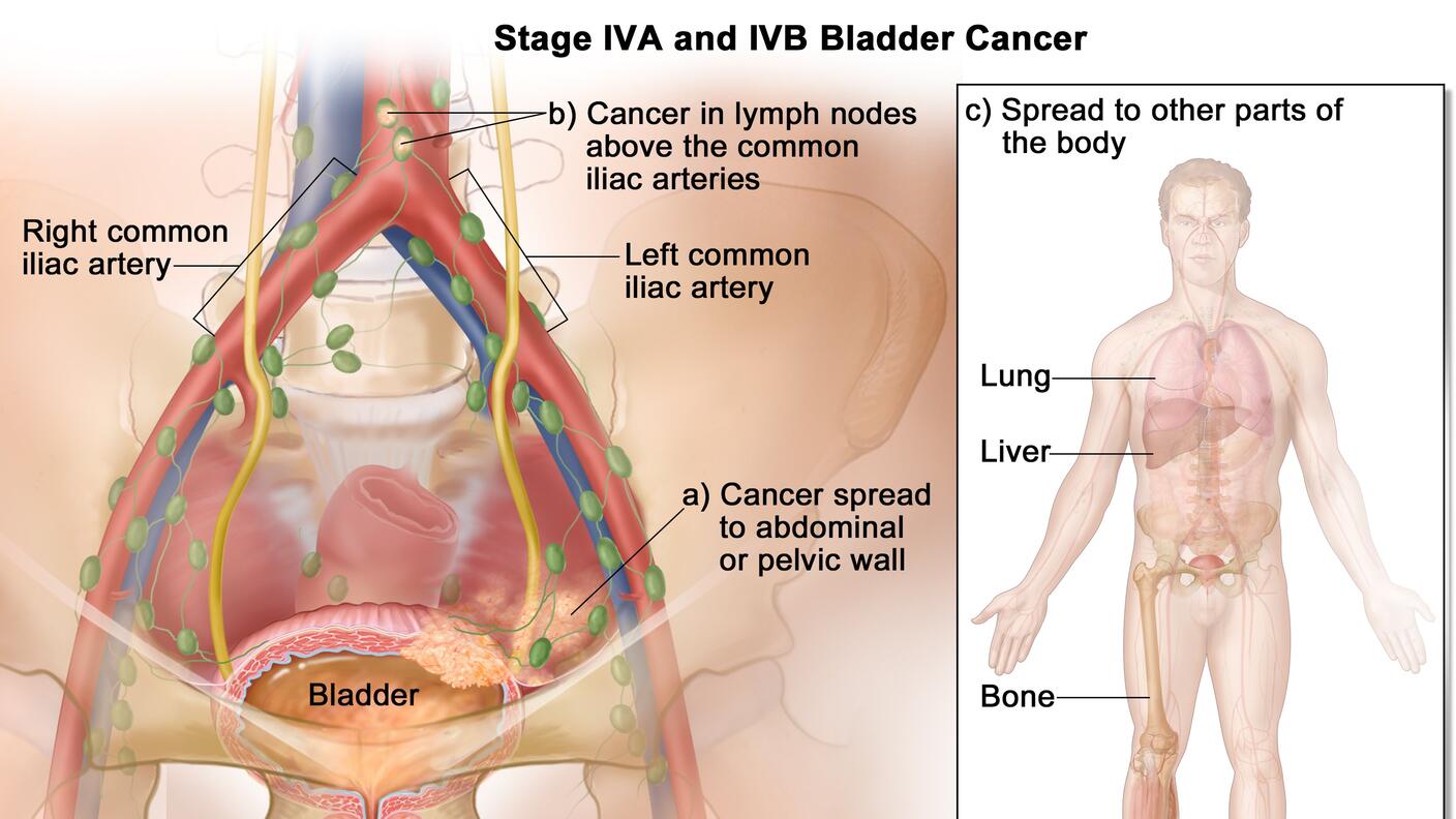 An illustration of blood cancer that has spread to other parts of the body.