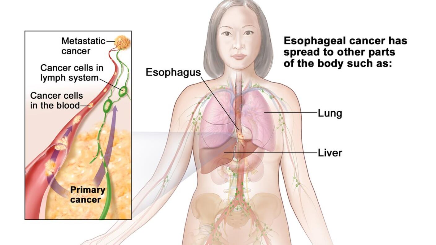 An anatomic illustration of stage IVB esophageal cancer.