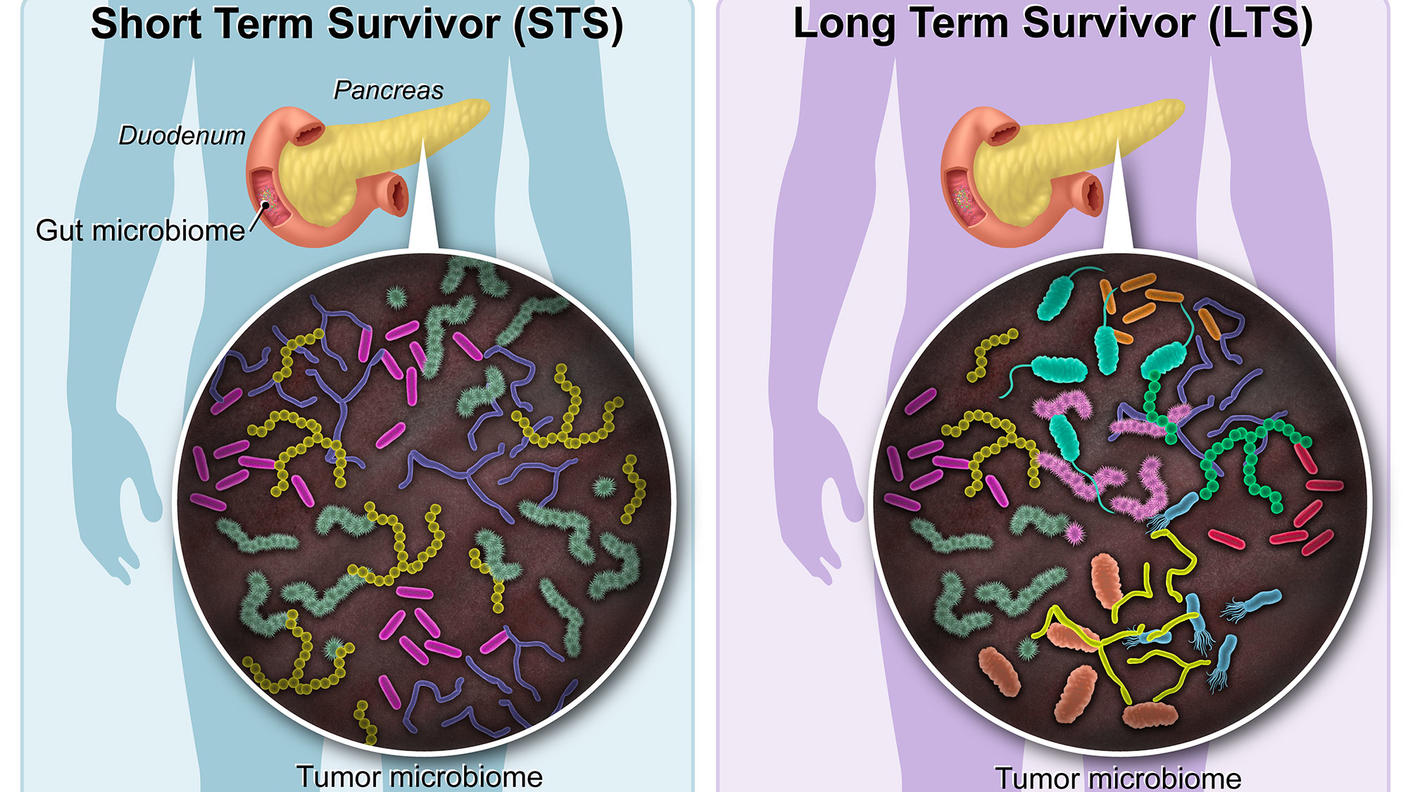 Illustration of tumor microbiome in short- and long-term survivors of pancreatic cancer.